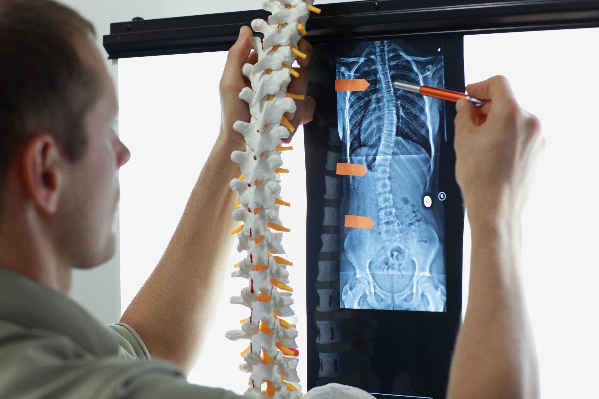 X-ray showing a sideways curvature of the spine characteristic of scoliosis